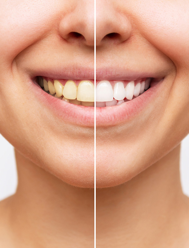 teeth-whitening